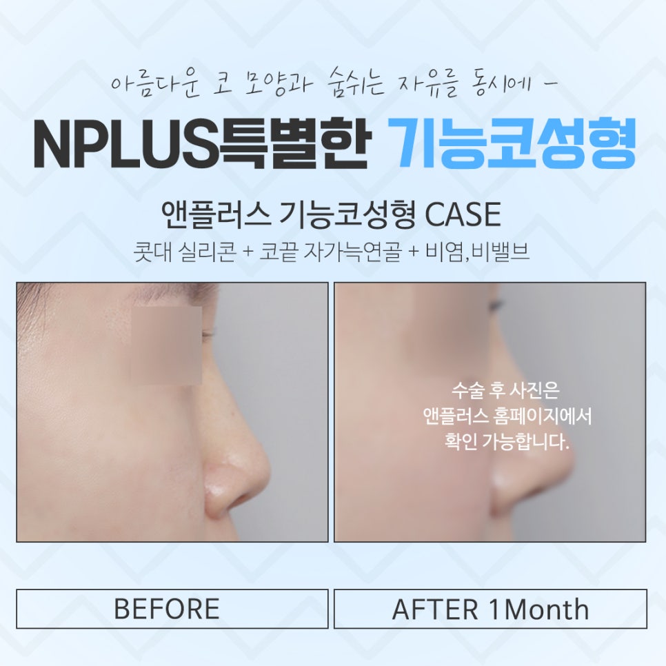 기능코성형후기를 신중하게 알아보고 관련 이미지 15