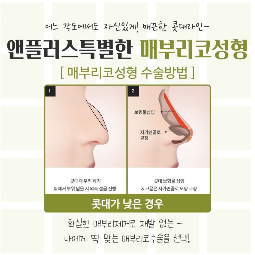 매부리코성형후기 정확한 진단을 통해 관련 이미지 10