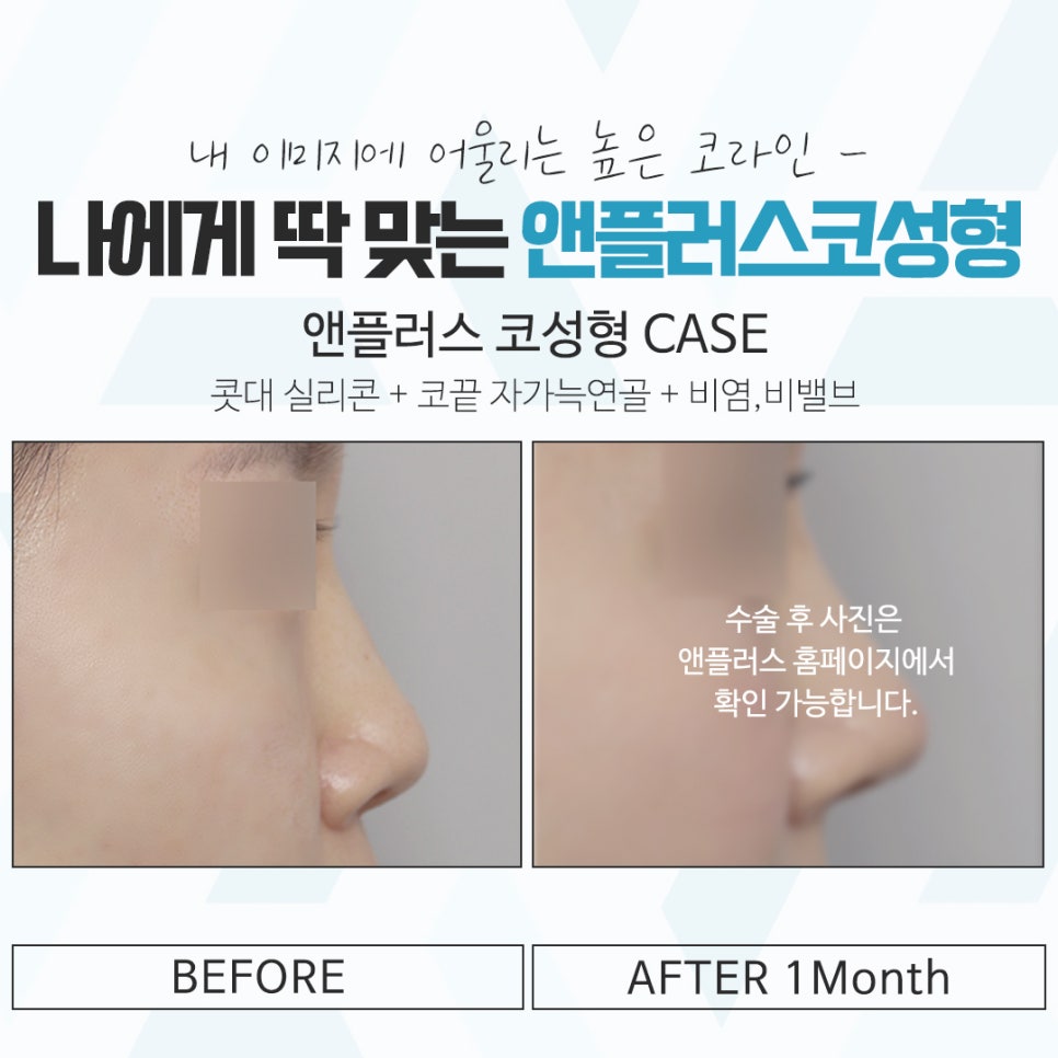 코성형후기 다양한 이미지를 고려하여 관련 이미지 14