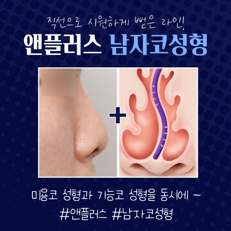 남자코성형전후 남자다운 직선라인으로 관련 이미지 3