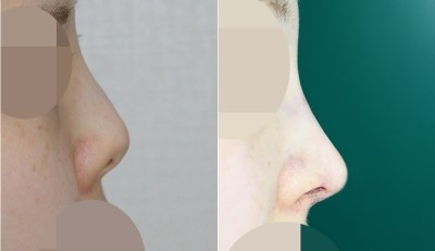 앤플러스 윤현철원장 - 구축코 줄기세포코재수술 실제 전후사진 관련 이미지 1
