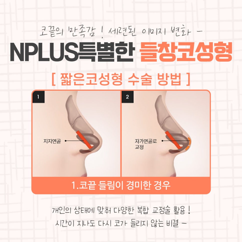 Learn More About Upturned Nose Rhinoplasty in Detail image 7