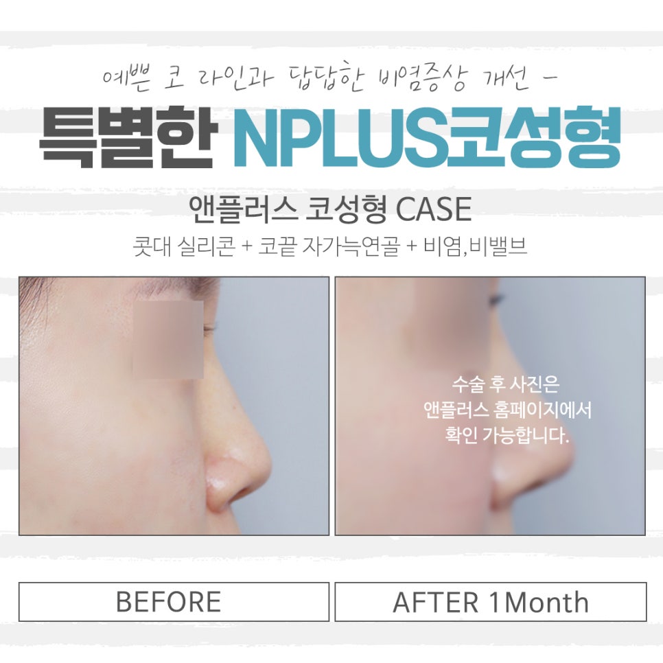 Reviewing Low Nose Surgery Reviews Carefully image 11