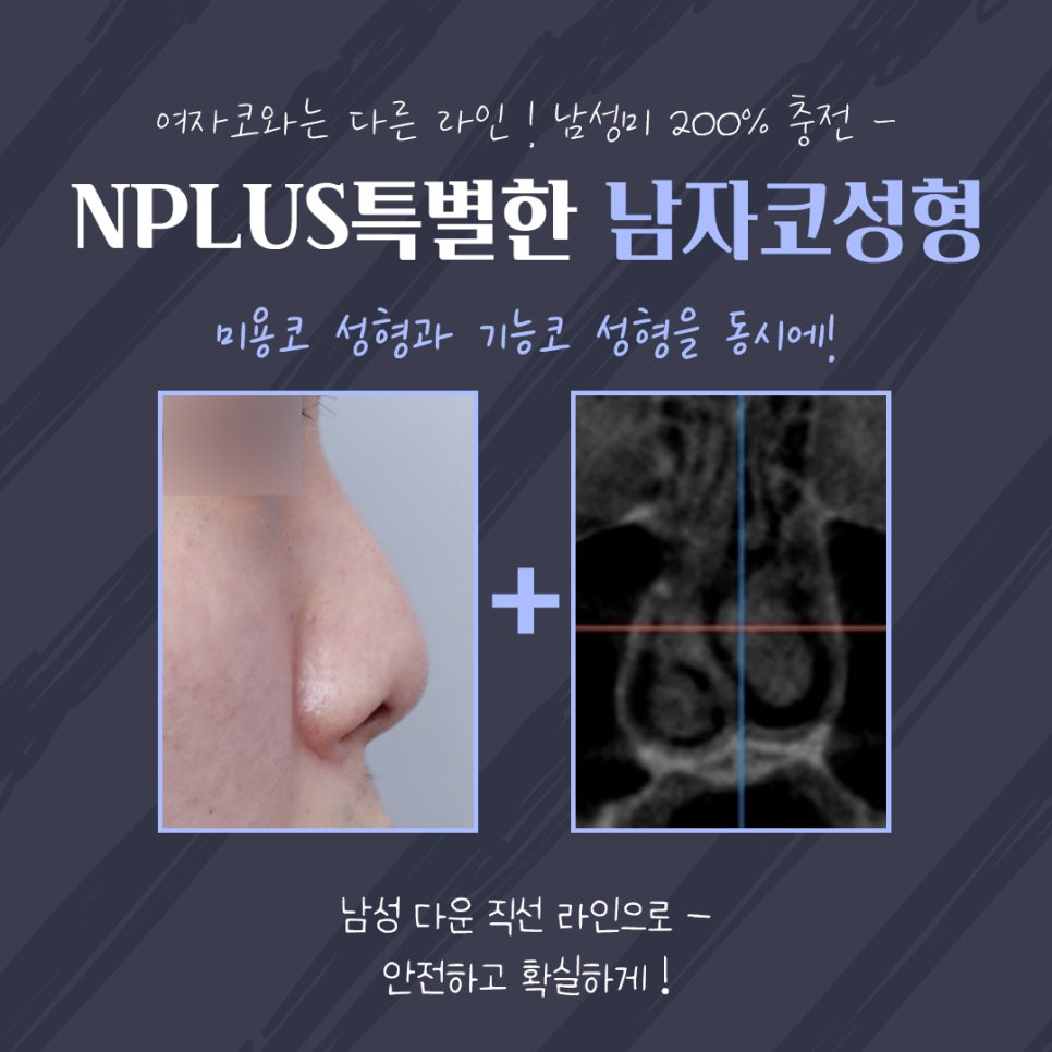 Rhinoplasty Review for Improving a Large Male Nose image 10