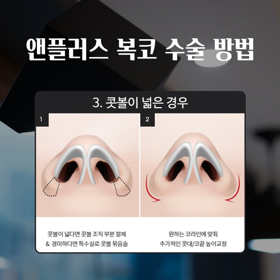 성형하기 힘든 코유형 관련 이미지 11