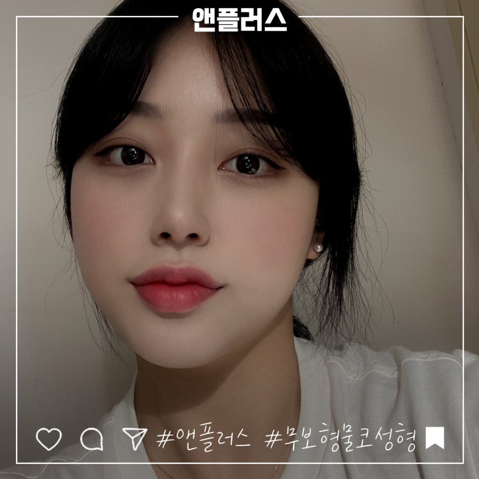 Non-Implant Rhinoplasty: Natural and Safe image 11