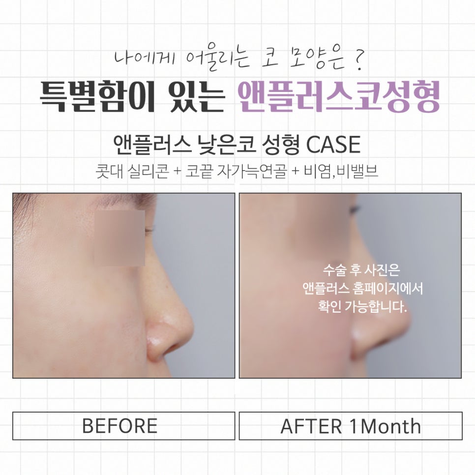 콧대수술 코 내부까지 정확하게 확인하고 관련 이미지 13