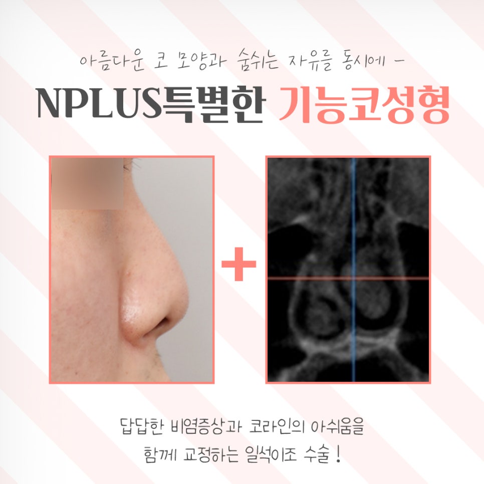 기능코성형후기 다양한 정보를 알아보고 관련 이미지 4