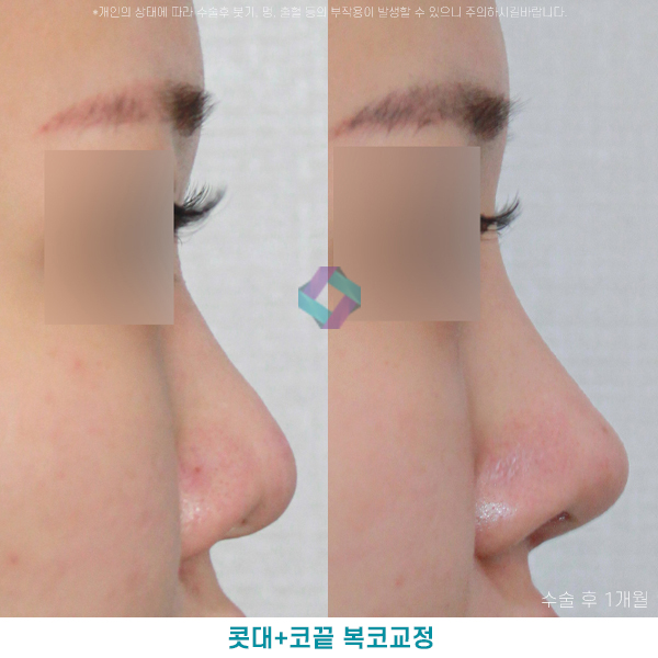 낮은코성형후기 참고하고 상담할때 관련 이미지 1