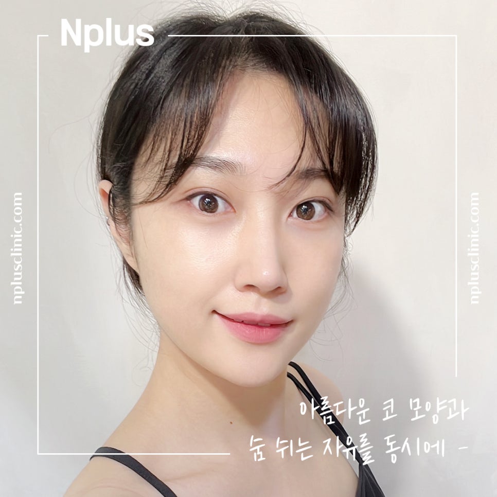 Before and After Nose Surgery: Looking into It Carefully image 12
