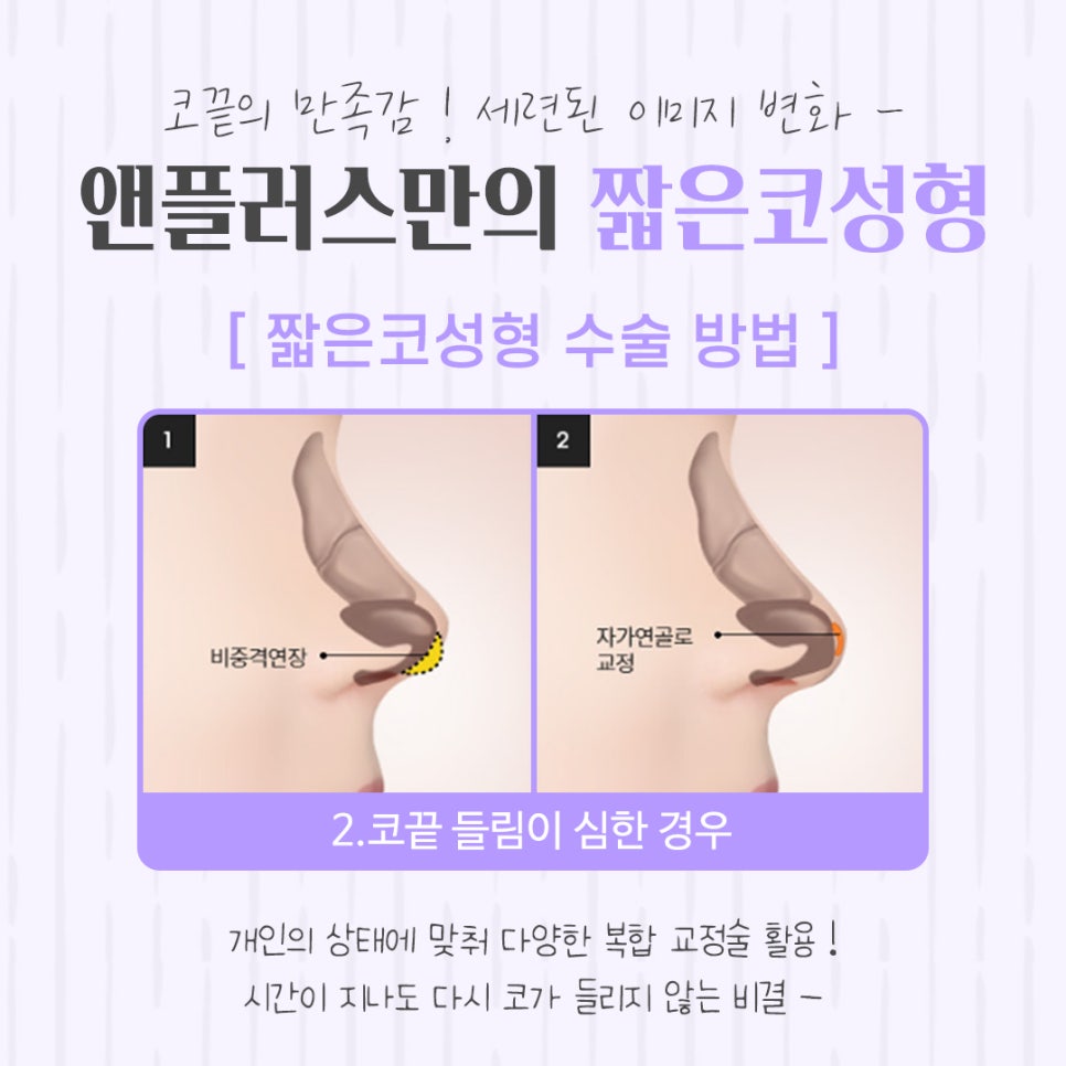 짧은코수술 후기까지 확실하게 관련 이미지 9