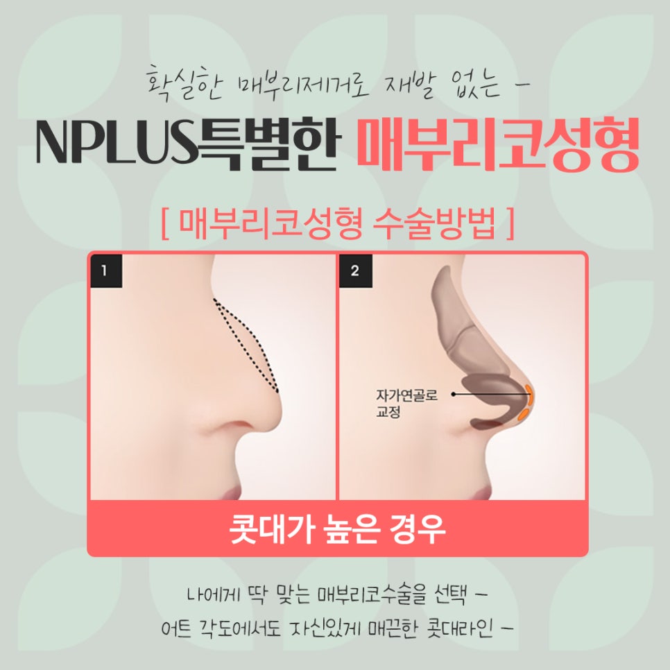 매부리코교정으로 부드러운 인상 관련 이미지 9