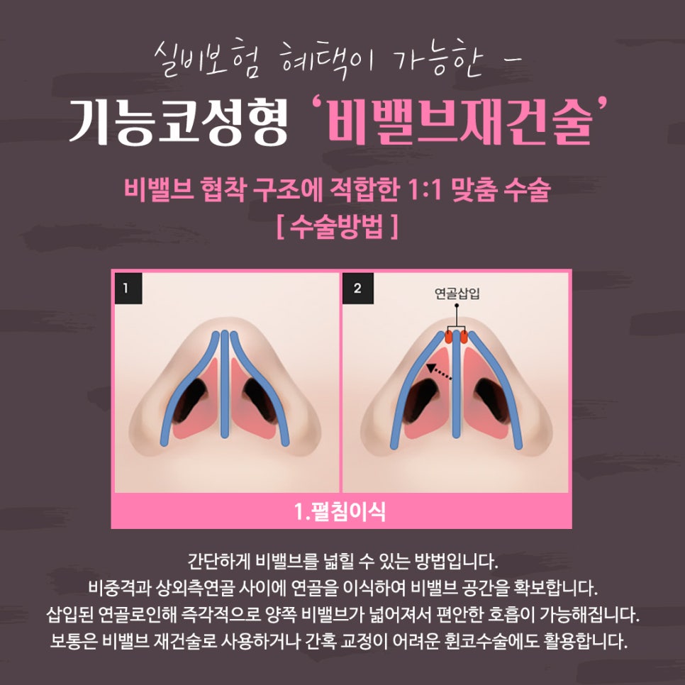 비밸브재건술 확실한 강남앤플러스에서 관련 이미지 10