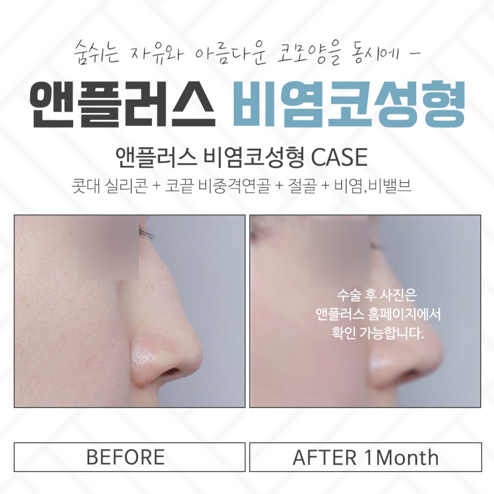 If You Are Checking Reviews of Rhinitis Nose Surgery image 13