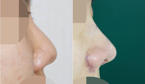 낮은 복코수술후기 전후사진 관련 이미지 1