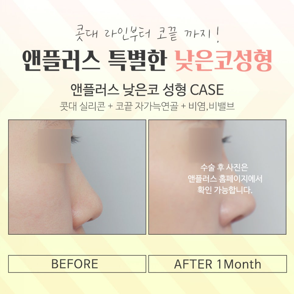 Creating a More Three-Dimensional Look with Low Nose Surgery image 12