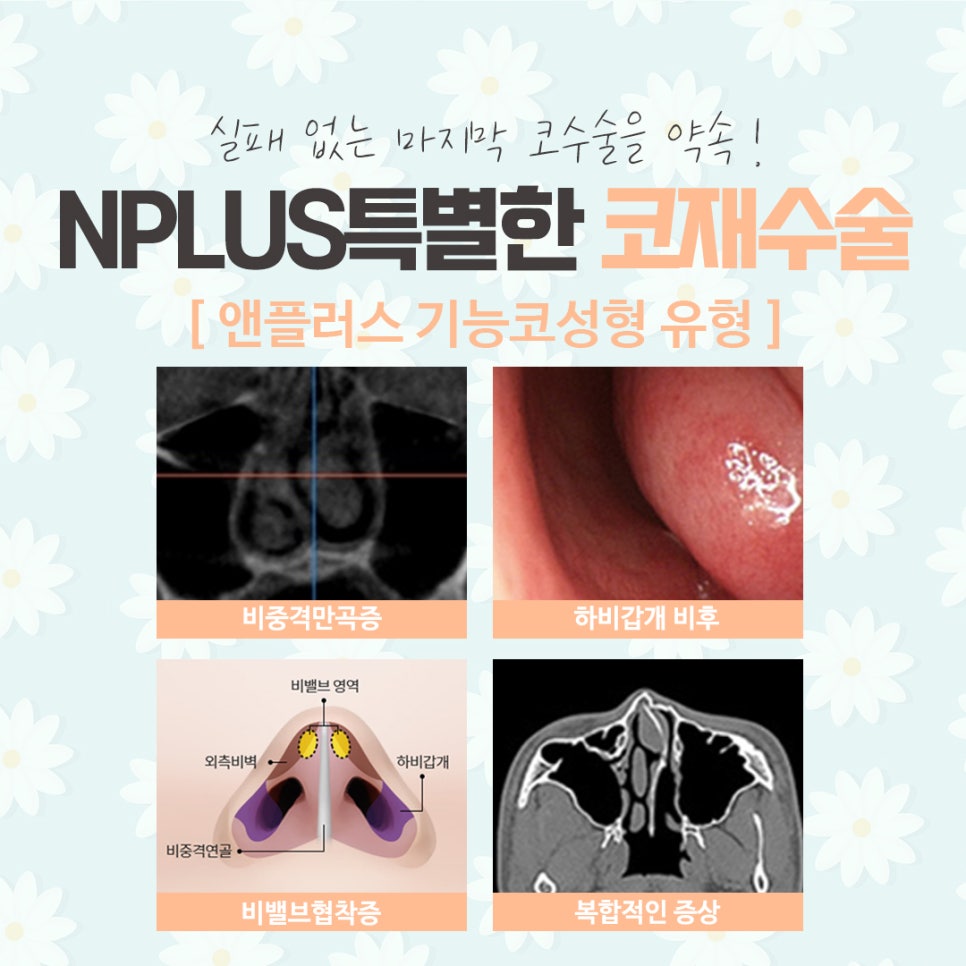 코재수술후기에 대해 자세하게 알아보고 관련 이미지 7