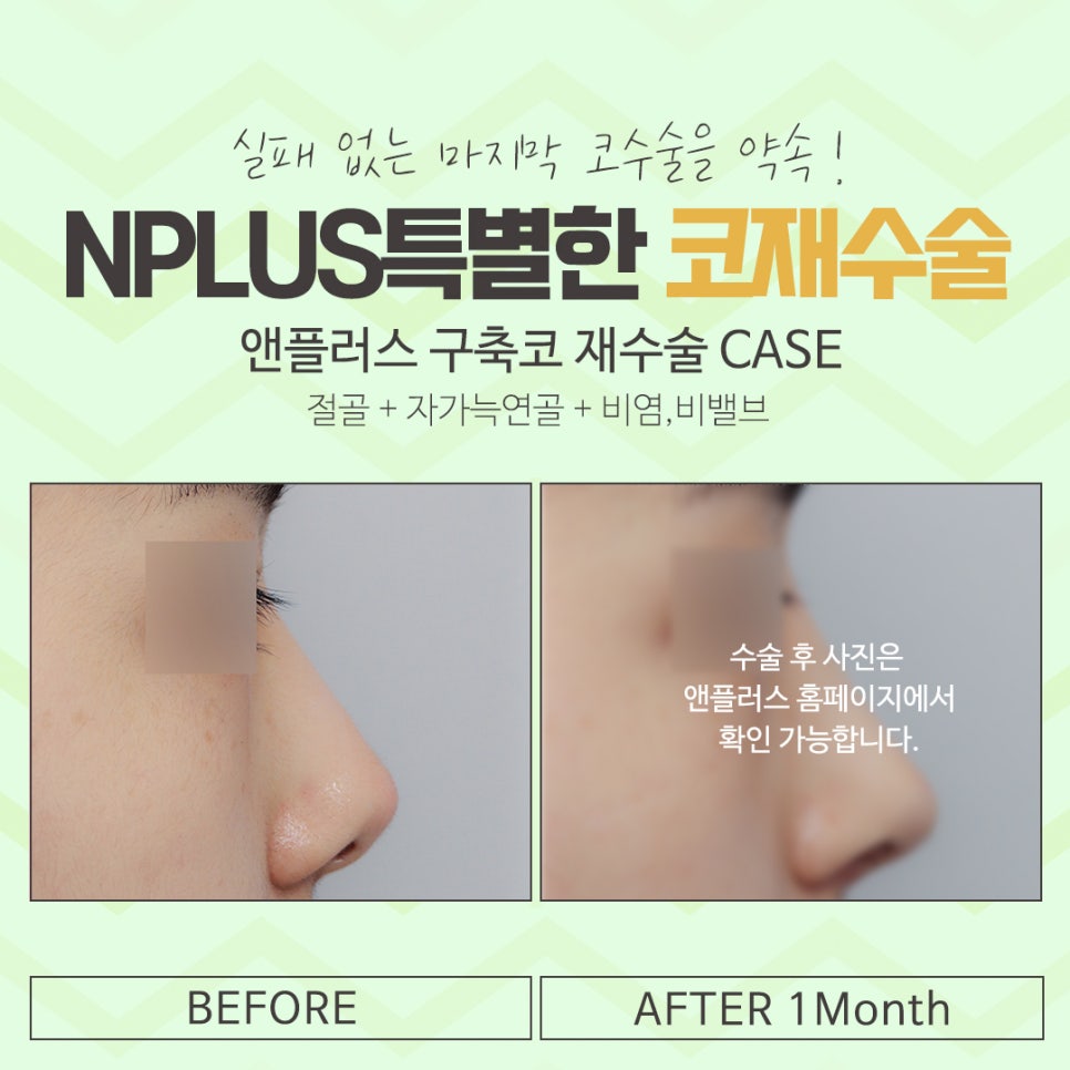 Nose Revision Surgery Review Considering Function as Well image 15