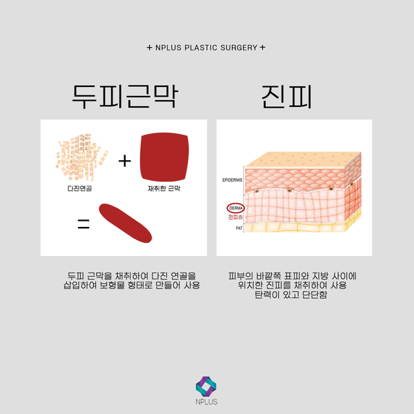 무보형물 코수술 자연스러운 코끝성형 관련 이미지 3