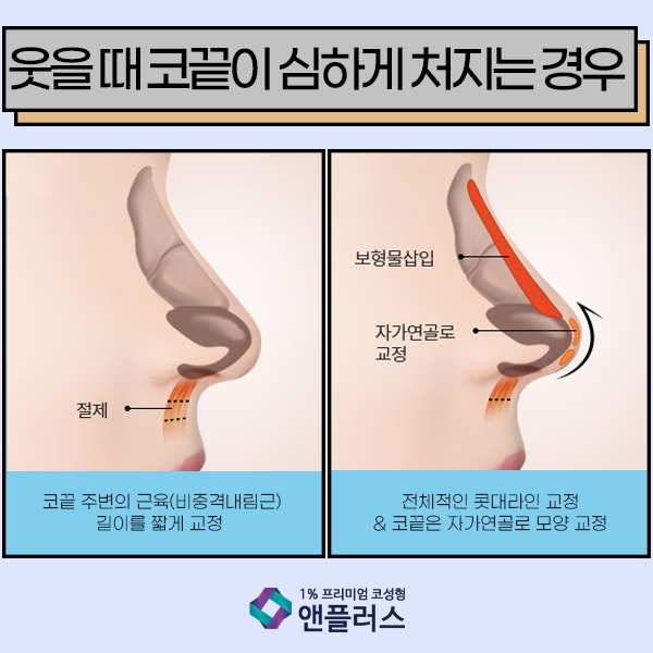 화살코성형 코끝이 고민일때 관련 이미지 6
