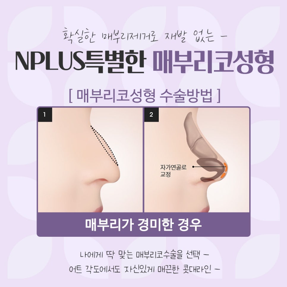 Check the Hump Nose Surgery Review in Detail image 10