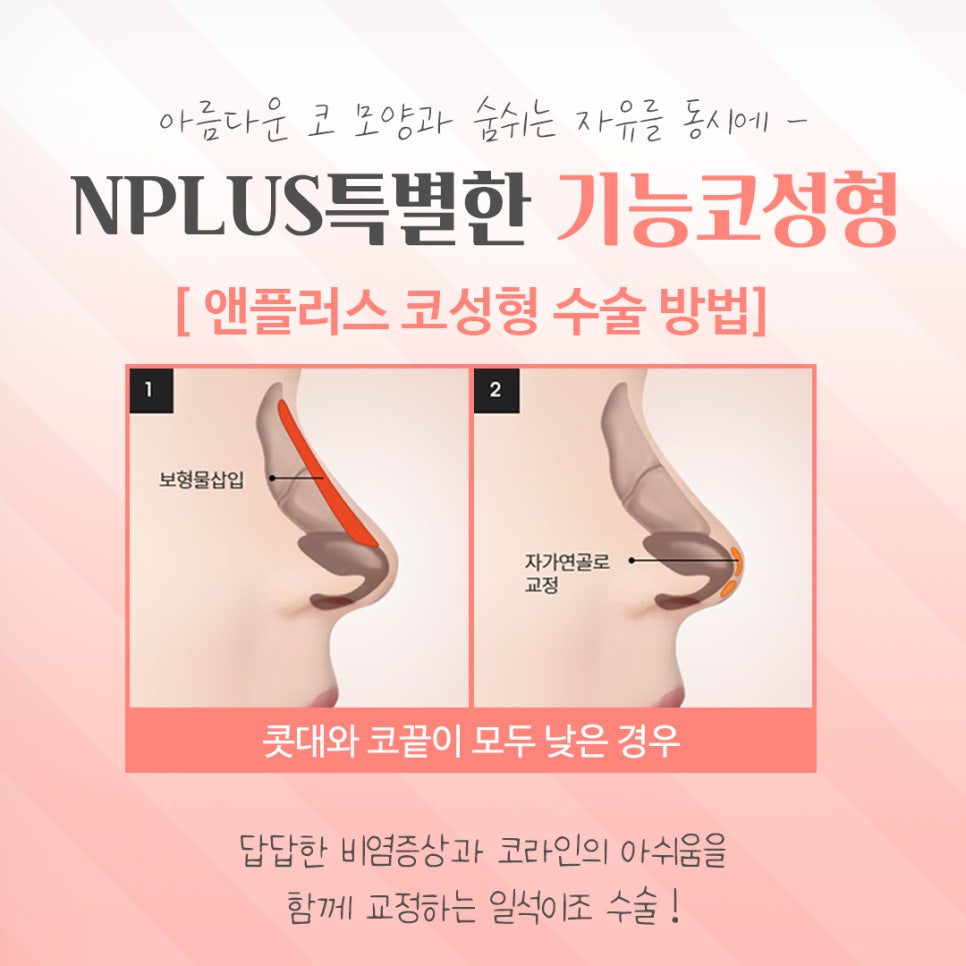 기능코성형전후를 찾아보고 관련 이미지 10