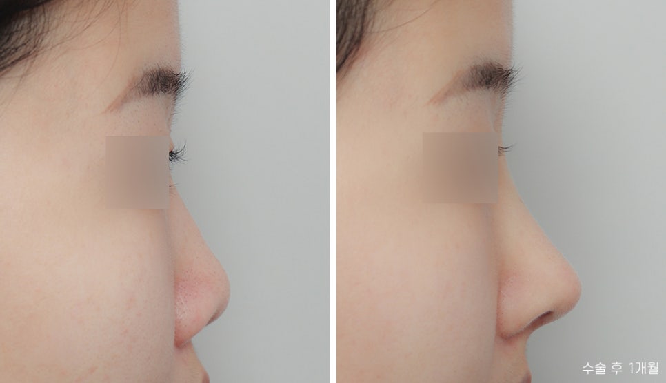 Let’s Find Confidence with a Small, Low Nose and a Beautiful Nose Shape! image 4