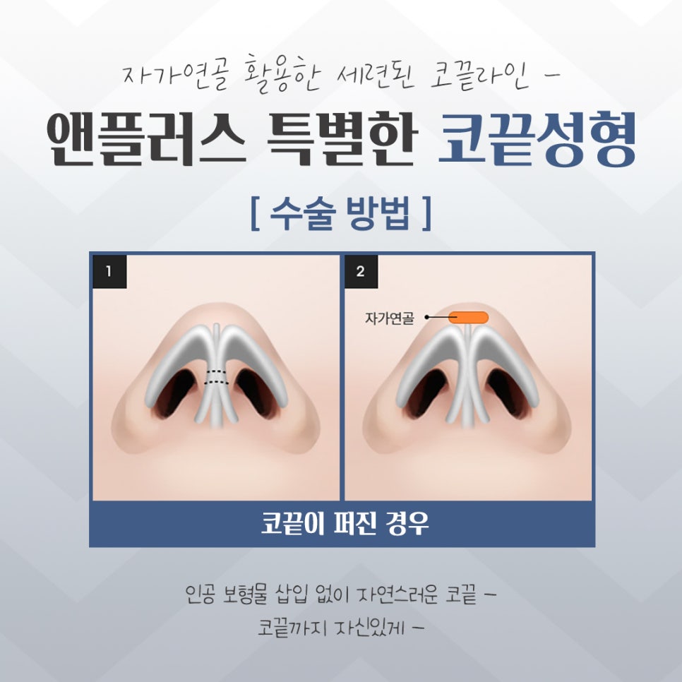 코끝수술후기에 대한 내용을 알아보고 관련 이미지 10