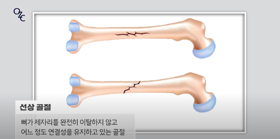 코뼈골절의 원인과 수술 방법에 대하여 관련 이미지 7