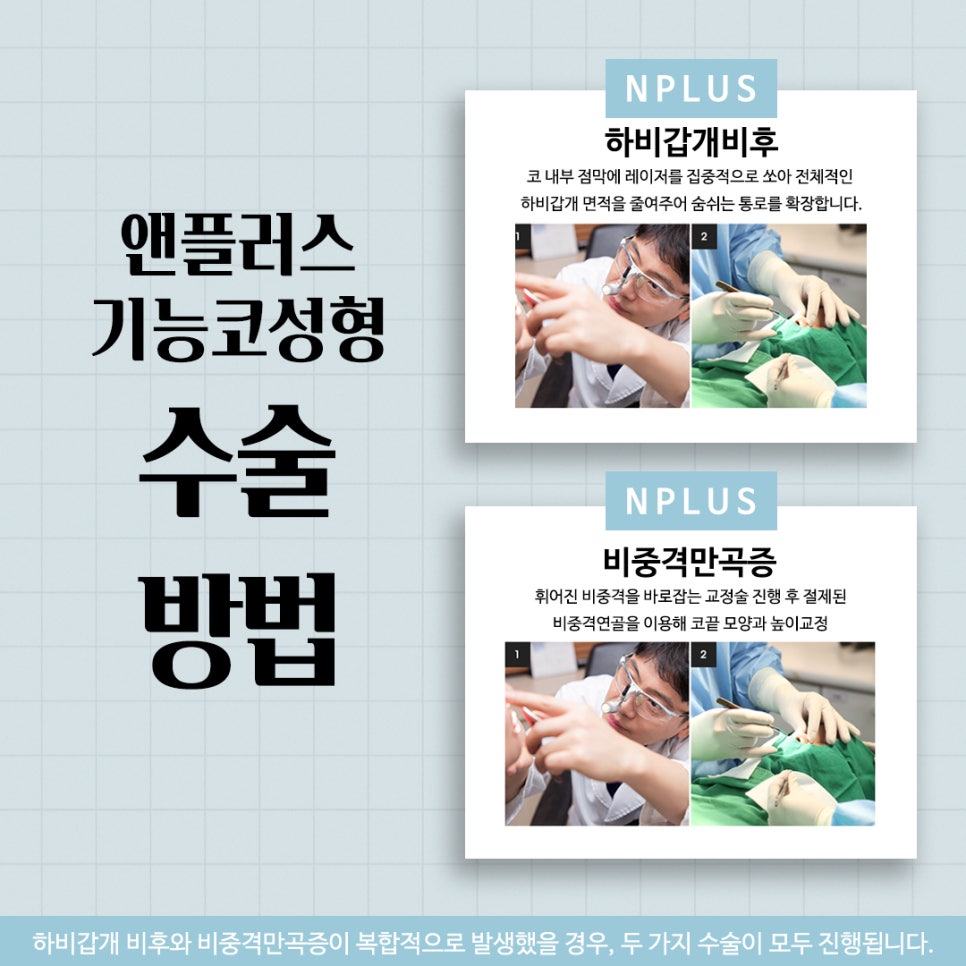 기능코성형비용을 다양하게 알아보고 관련 이미지 10
