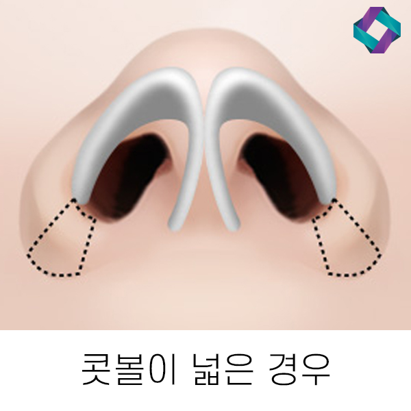 복코성형 유형에 따라 다른 수술방법 관련 이미지 5