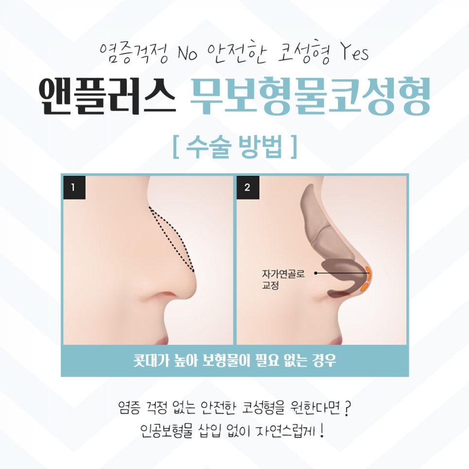 무보형물코성형후기 자연스러운 이미지로 관련 이미지 6