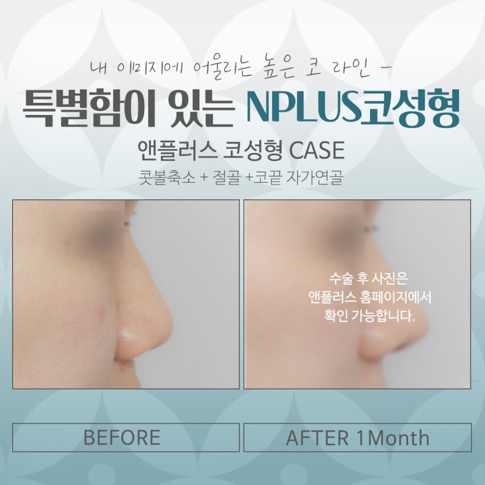 Looking Into Information About Gangnam Nose Surgery image 14