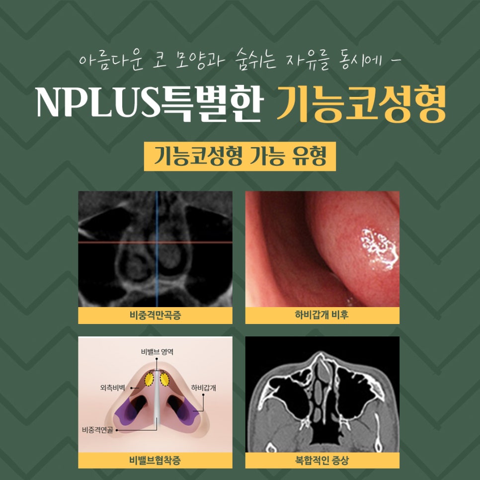 기능코성형후기 꼼꼼하게 알아보고 관련 이미지 6