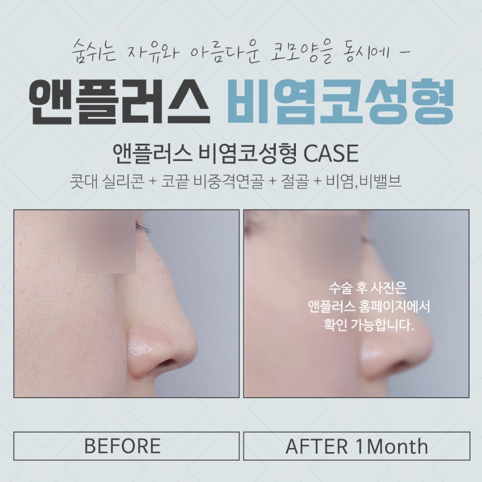 비염코성형후기 원인을 자세하게 알아보고 관련 이미지 14