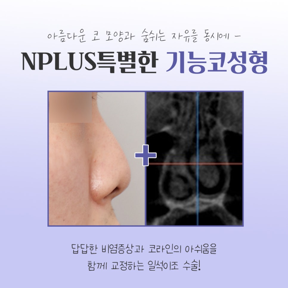 Check the Difference in Functional Nose Surgery Reviews image 3