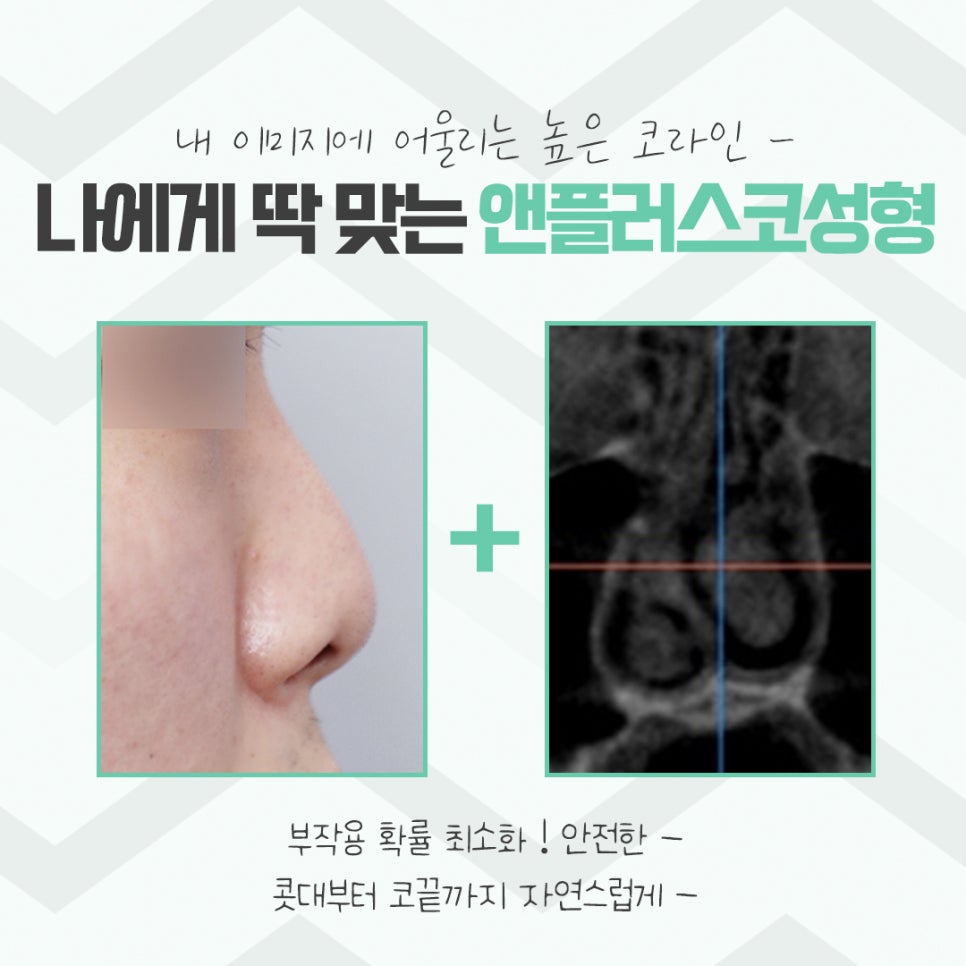 코성형후기 자연스러운 코라인으로 관련 이미지 5