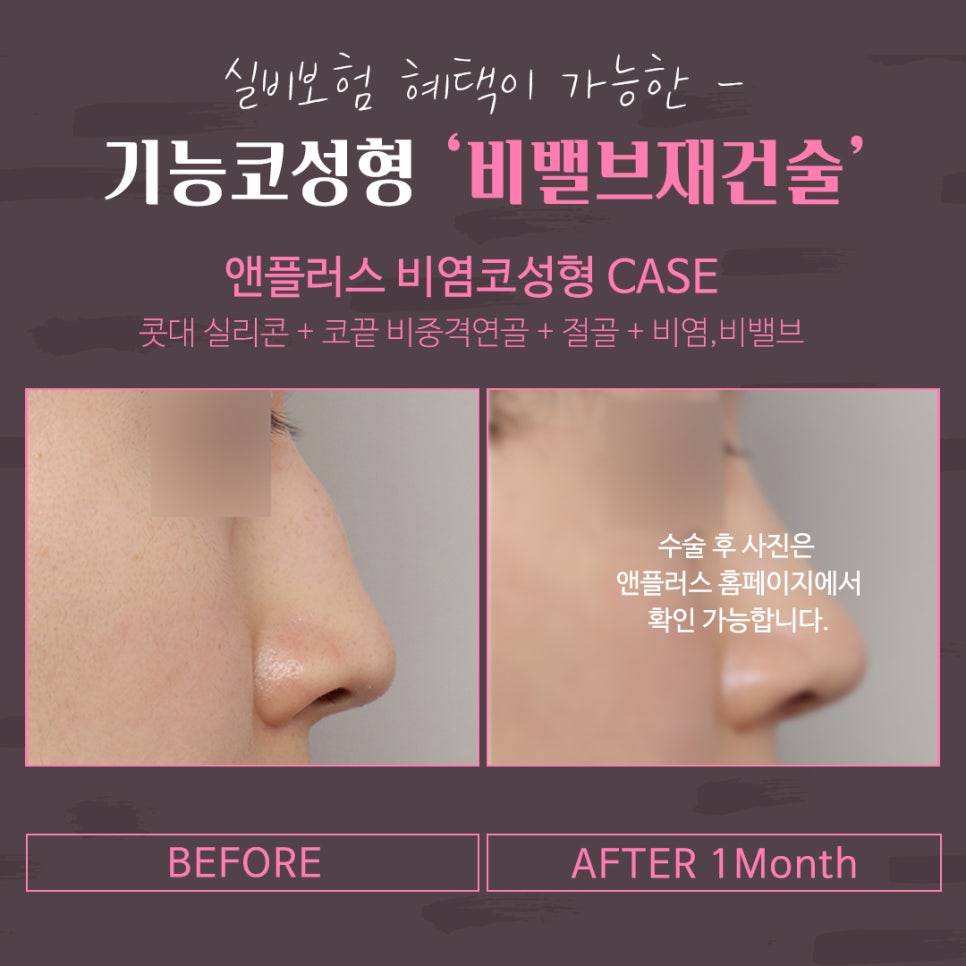 비밸브재건술 확실한 강남앤플러스에서 관련 이미지 3