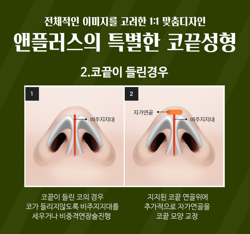 강남코성형 예쁜 코끝성형으로 이미지 개선 관련 이미지 6