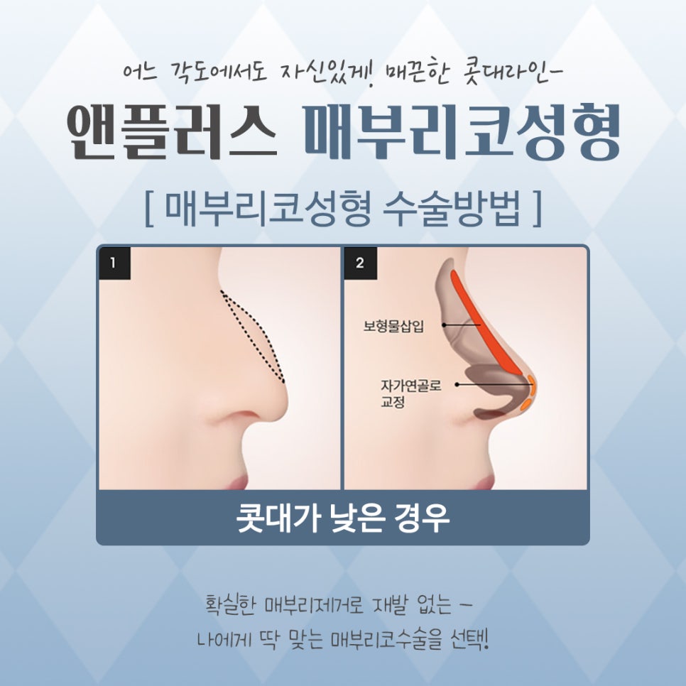 Looking into Cases of Before and After Hump Nose Surgery image 9