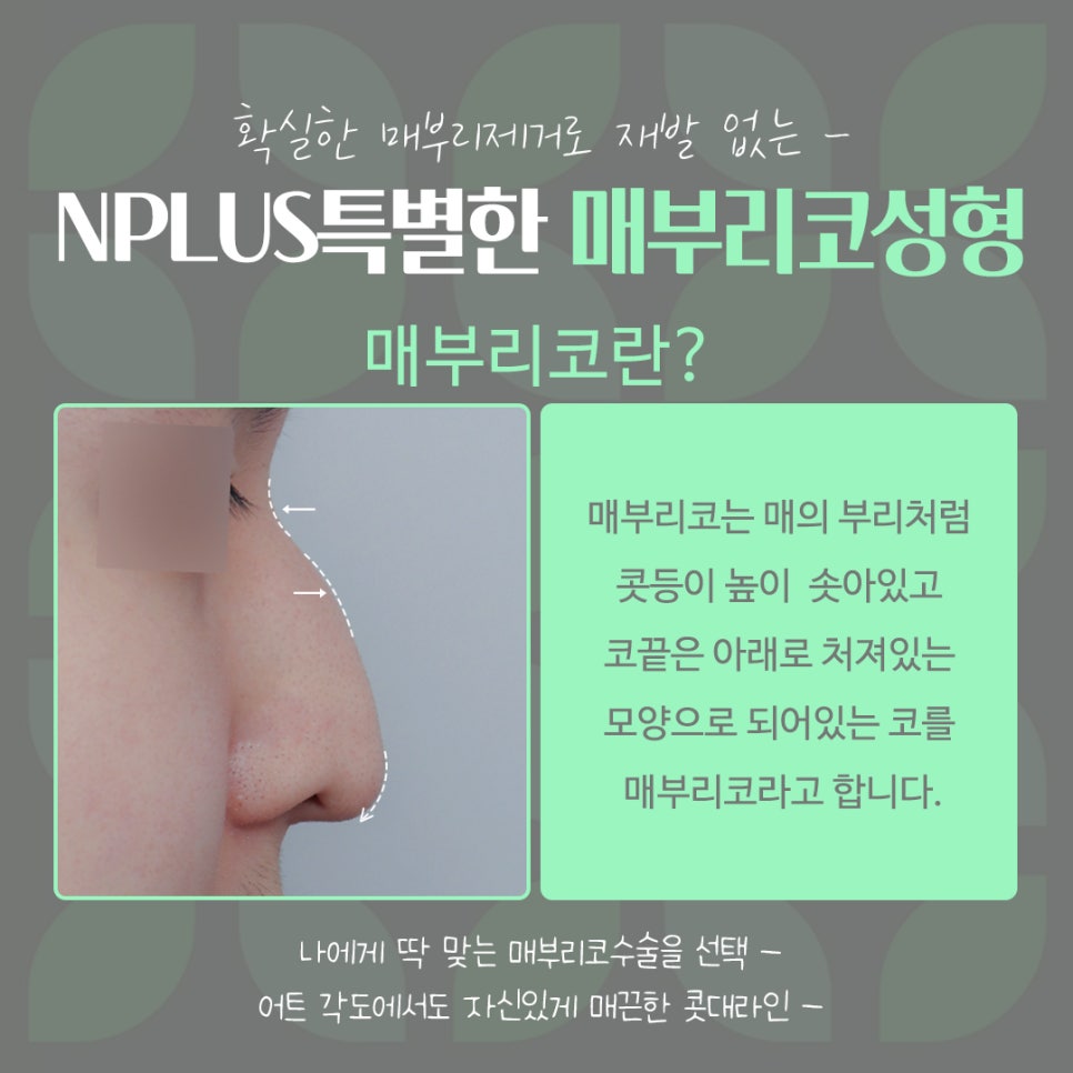 Septoplasty and Hump Nose Surgery Review, Considering Function Too image 4