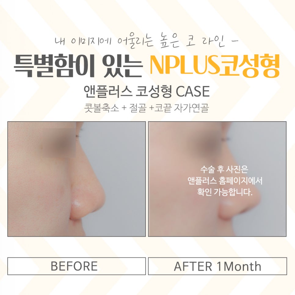 코성형잘하는곳에서 세련된 라인으로 관련 이미지 14
