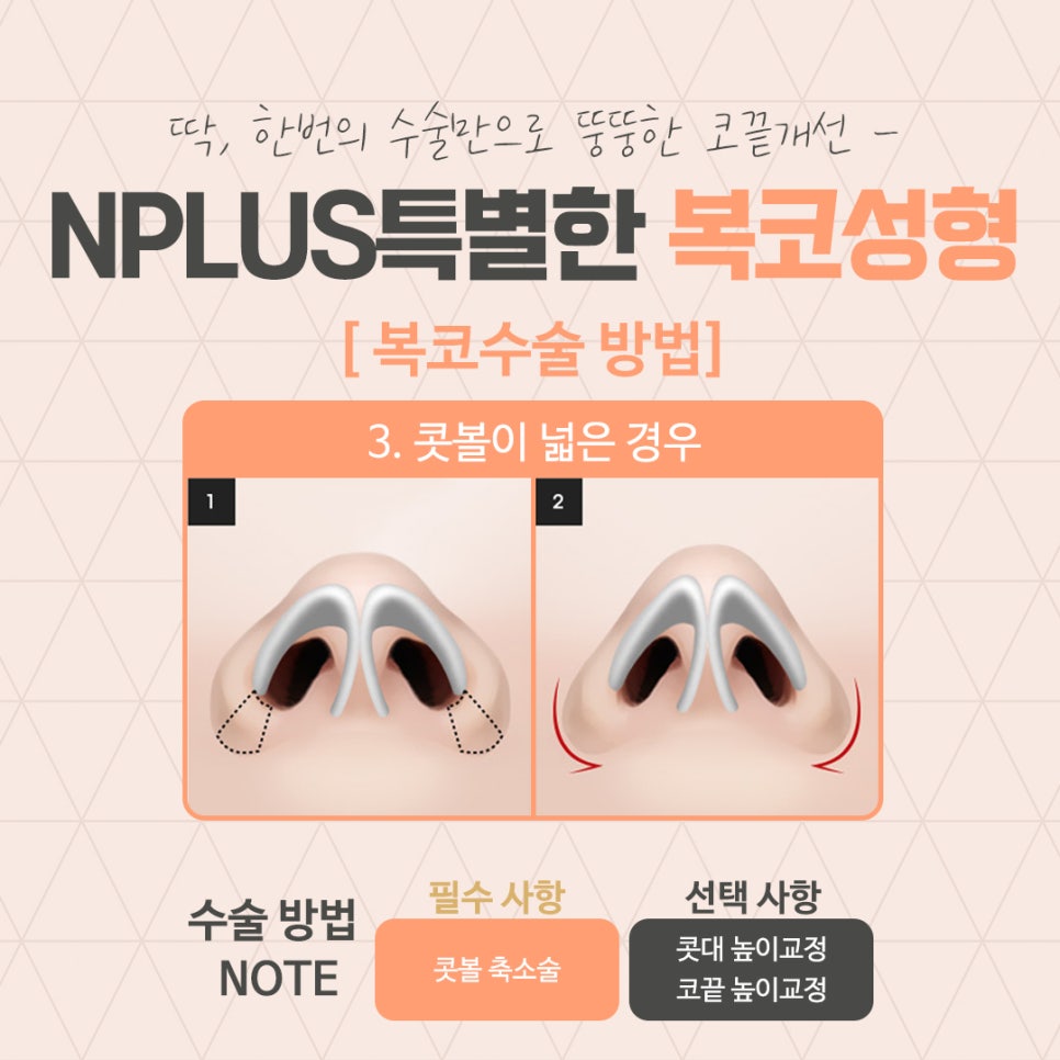 A Clear Bulbous Nose Surgery Review with Nasal Fat Removal image 8