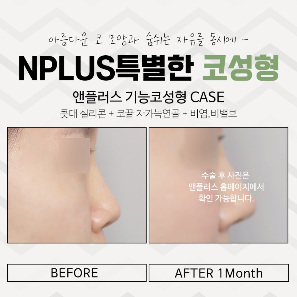 코수술전후 확실한 차이를 알아보고 관련 이미지 12
