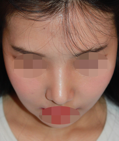 1_여자 매부리코 수술전후 관련 이미지 12