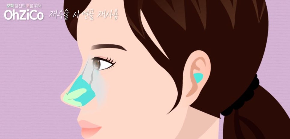 Let Us Explain Whether Cartilage Can Be Reused in Revision Rhinoplasty! image 5