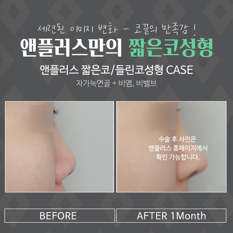Elevating the Columellar Support to Complete Short Nose Surgery image 11