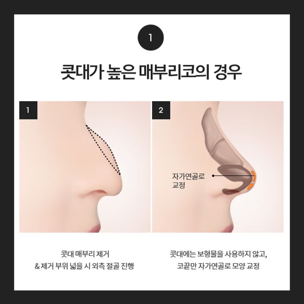 Hooked Nose Before-and-After Photos for a Softer Look image 6