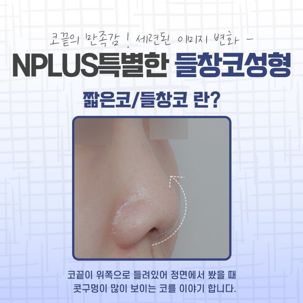 들창코성형 후기를 비교해 보고 관련 이미지 4