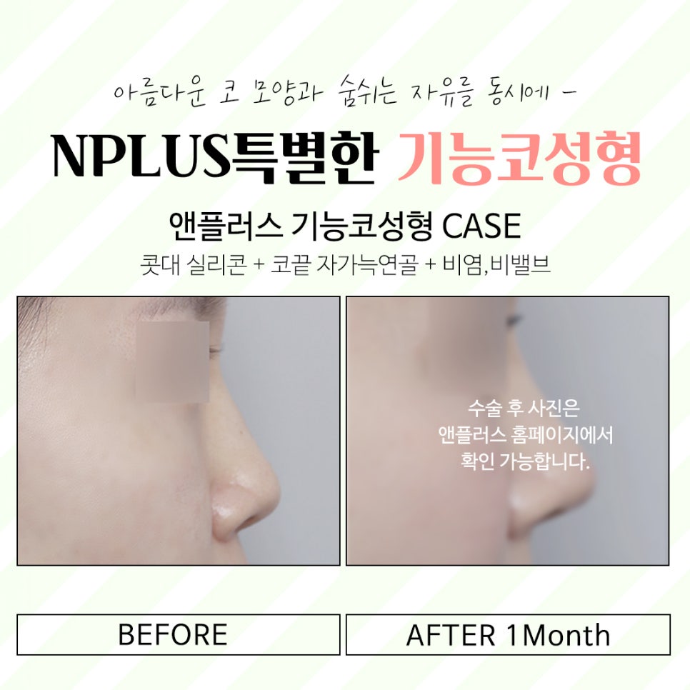 코성형후기 제대로 알아보고 관련 이미지 14